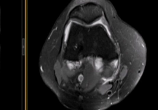 微創(chuàng)射頻消融術(shù) 微創(chuàng)射頻消融術(shù)